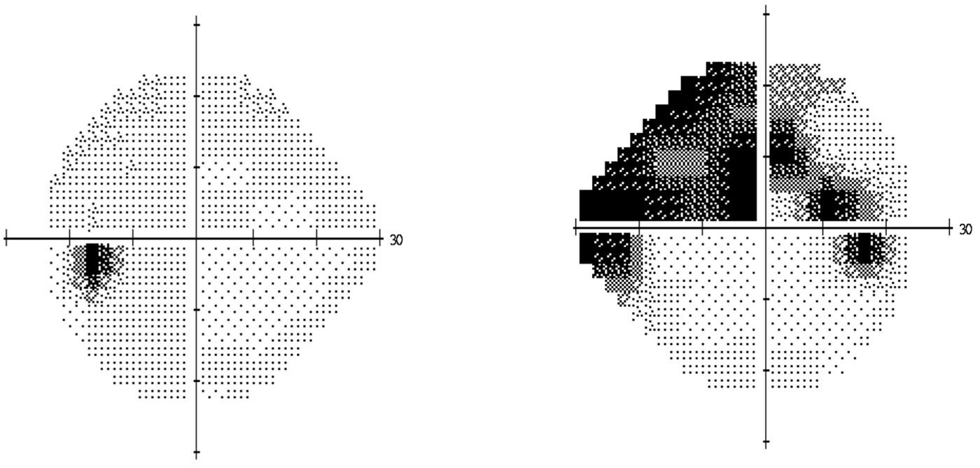 Glaucoma Information How Is The Visual Field Examined Glaucoma 