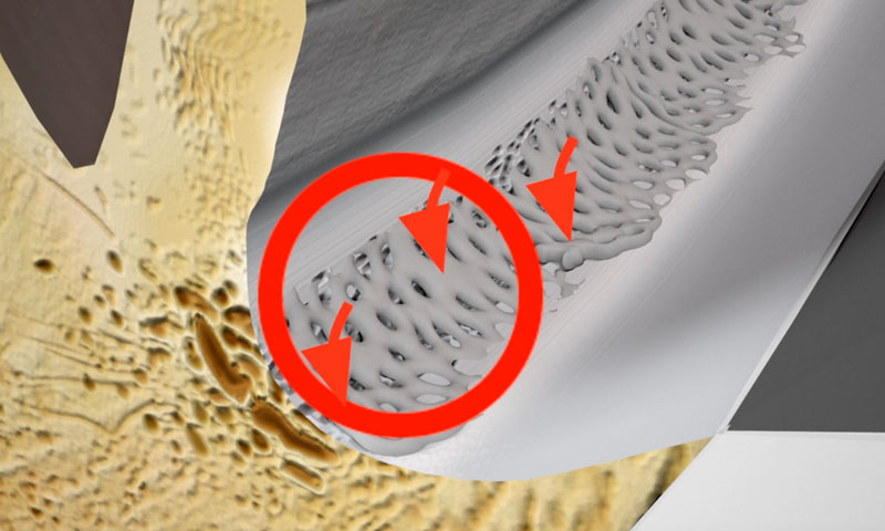 Glaucoma Information Drainage System Of The Eye Glaucoma Information